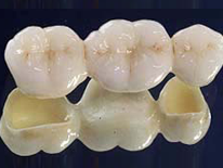 Kronen und Brücken Zahnarzt